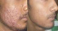 Face pimple(Acne) removal annd skin whitening ice cream 120ml