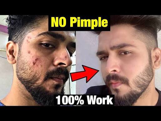 Face pimple(Acne) removal annd skin whitening ice cream 120ml