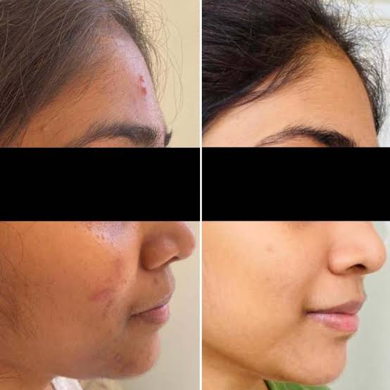 Face pimple(Acne) removal annd skin whitening ice cream 120ml