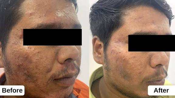 Face pimple(Acne) removal annd skin whitening ice cream 120ml